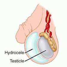Hydrocèle testiculaire